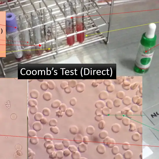 coombs test (direct)